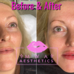 Lip Dermal Filler treatment Leeds