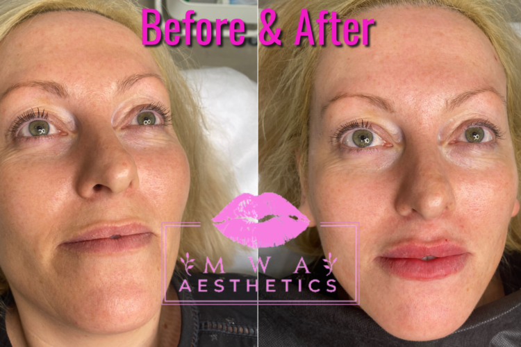 Lip Dermal Filler treatment Leeds