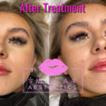 Leeds Lip Filler Treatment