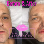 Male Lip Filler Treatment Leeds