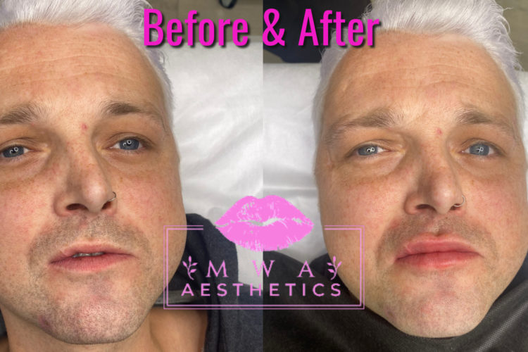 Male Lip Filler Treatment Leeds